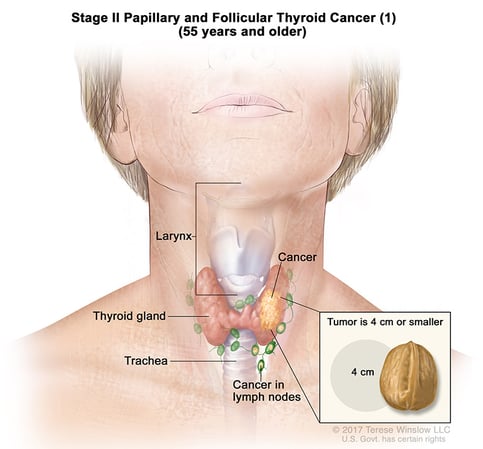 A medical illustration of stage 2 of papillary and follicular thyroid cancer in people aged 55 and older.