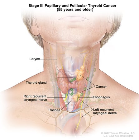 A medical illustration of stage 3 of papillary and follicular thyroid cancer in people aged 55 and older.