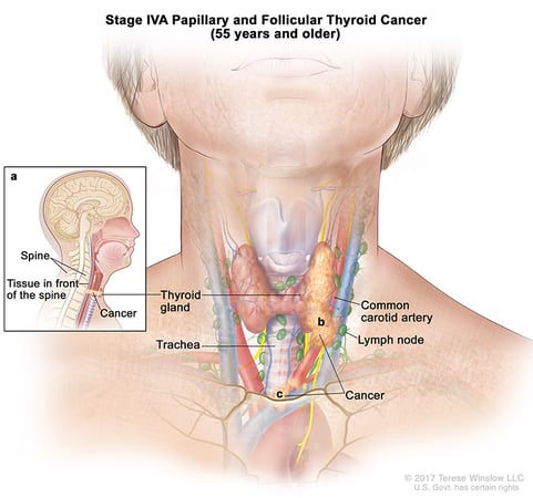 A medical illustration of stage 4A of papillary and follicular thyroid cancer in people aged 55 and older.