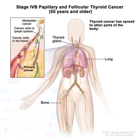 A medical illustration of stage 4B of papillary and follicular thyroid cancer in people aged 55 and older.