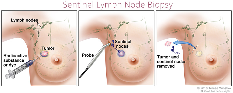 Ilustración médica que muestra cómo funciona una biopsia del ganglio linfático centinela. Se inyecta una sustancia radiactiva o colorante en la mama y, a continuación, se utiliza una sonda para extirpar el tumor y los ganglios centinela.