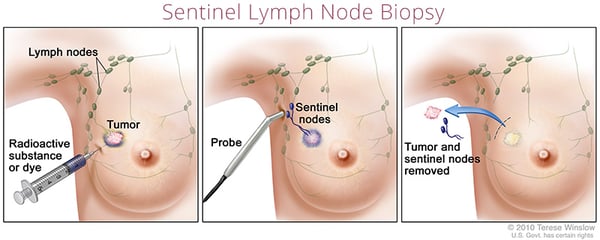 biopsia de nódulo centinela de la mama