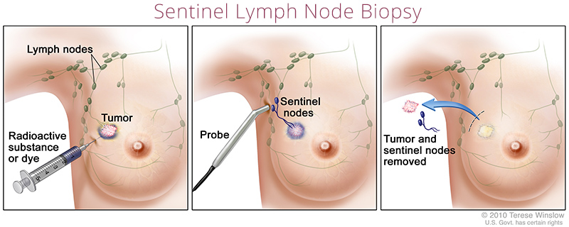 биопсия сентинельного узла молочной железы