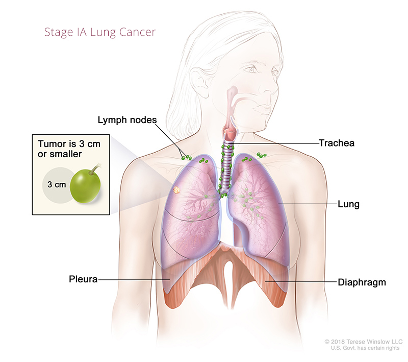 lung-cancer-stage1A-1