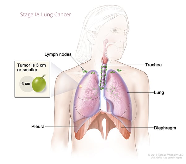 cáncer de pulmón-estadio1A-1