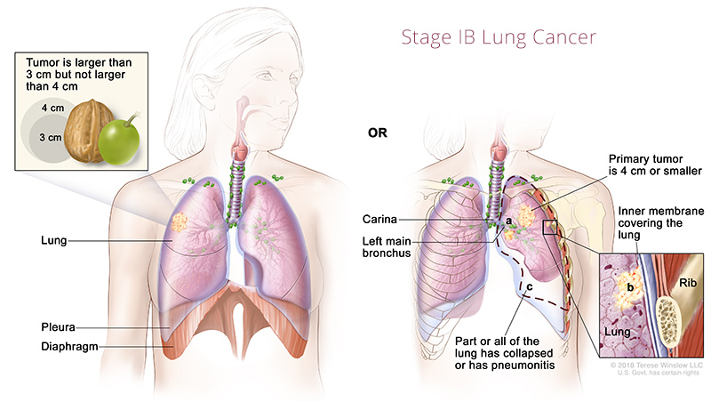 lung-cancer-stage1B