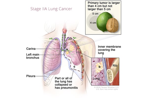 cáncer de pulmón-estado2A