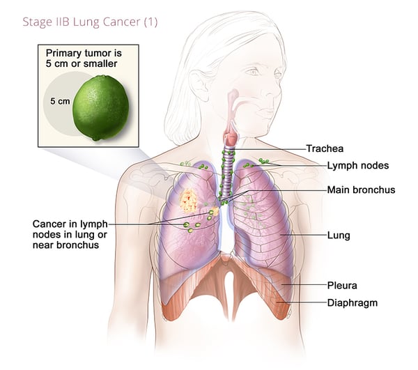 cáncer de pulmón-estadio2B1