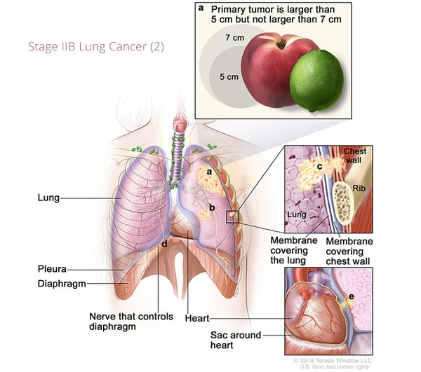 cáncer de pulmón-estadio2B2