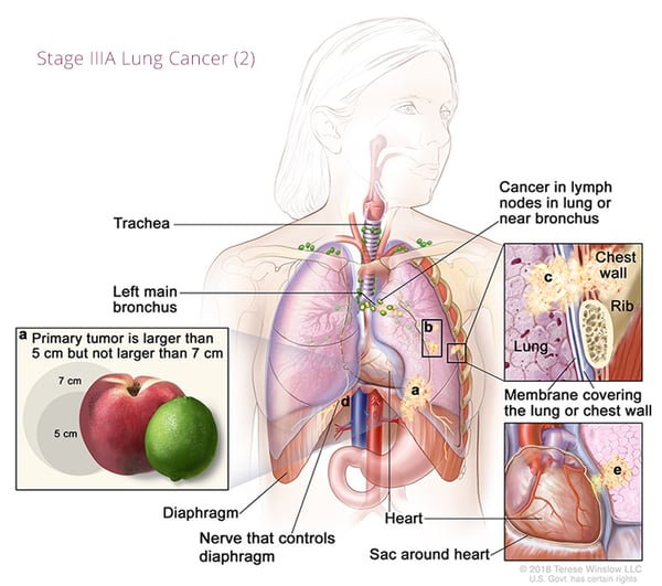 cáncer de pulmón-estadio3A2