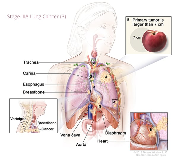 cáncer de pulmón-estadio3A3