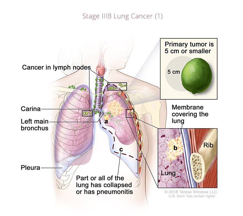 lung-cancer-stage3B1