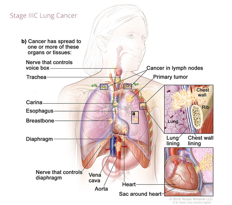 lung-cancer-stage3C