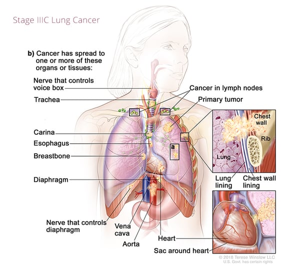 cáncer de pulmón-estado3C