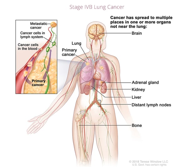 cáncer de pulmón-estadio4B