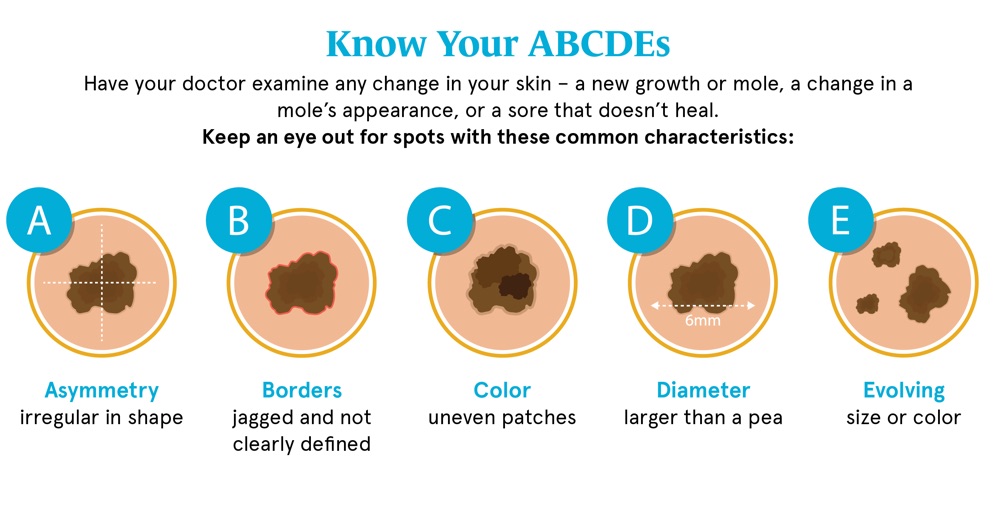 Skin cancer signs