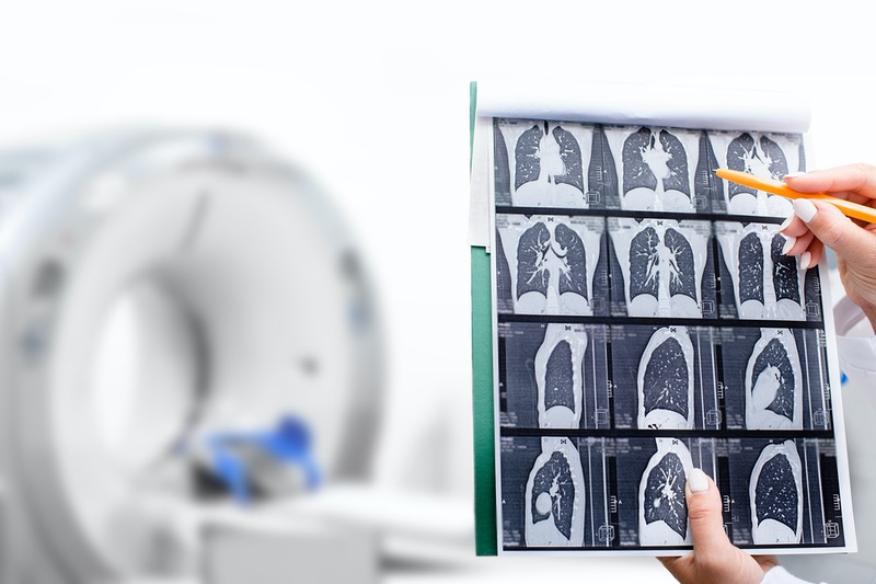 doctor reviewing scans of a patient's lungs