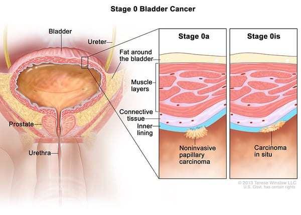 bladder-cancer-stage-0a0is