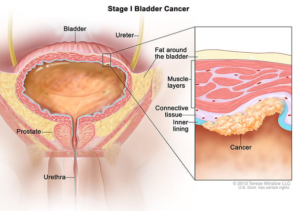 bladder-cancer-stage-1