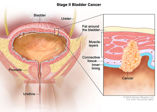 bladder-cancer-stage-2