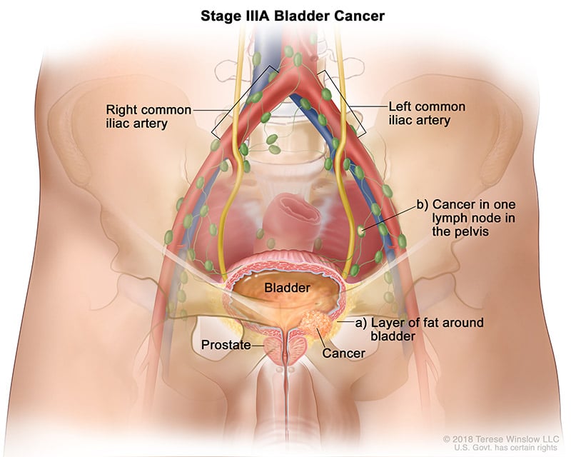 bladder-cancer-stage-3A