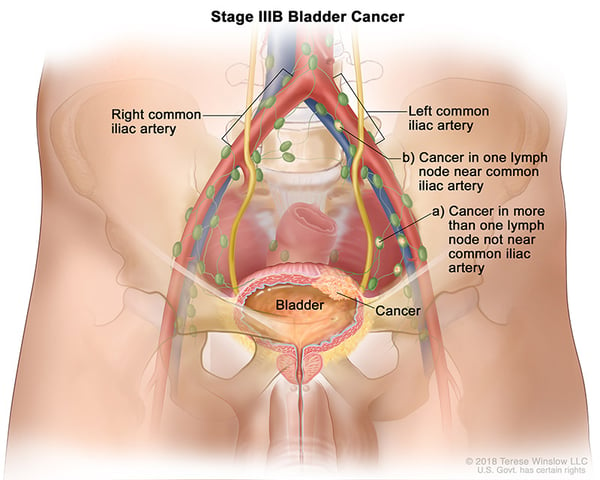 bladder-cancer-stage-3B