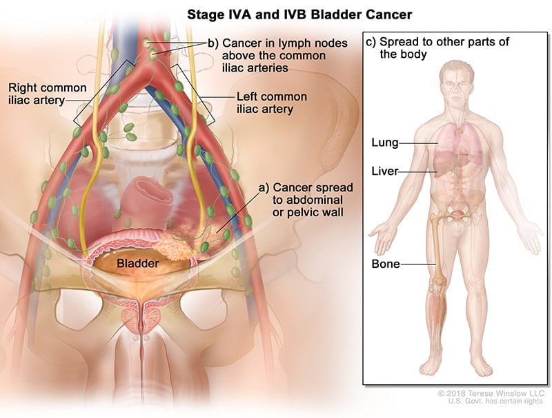 bladder-cancer-stage-4AB