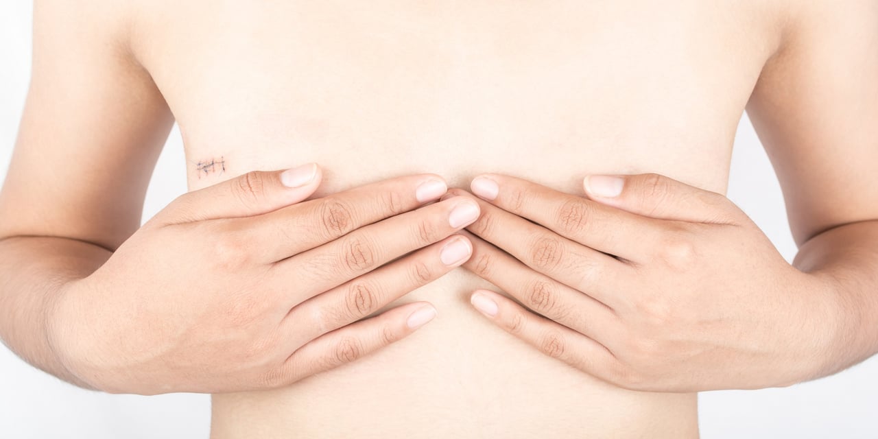 Choosing Breast Reconstruction After a Mastectomy