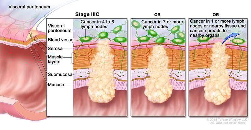 colorectal-ca-stage-3C