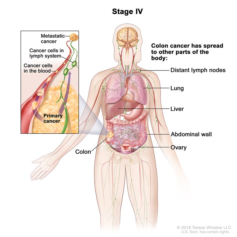 colorectal-ca-stage-4