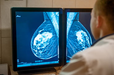 ¿Cuál es el mejor tratamiento para el cáncer de mama en estadio 0?
