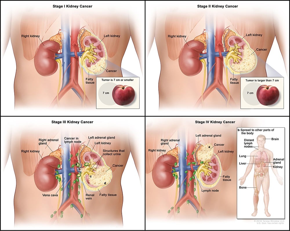 etapas del cáncer de riñón