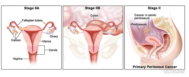 ofp-ca-stage-2ABC