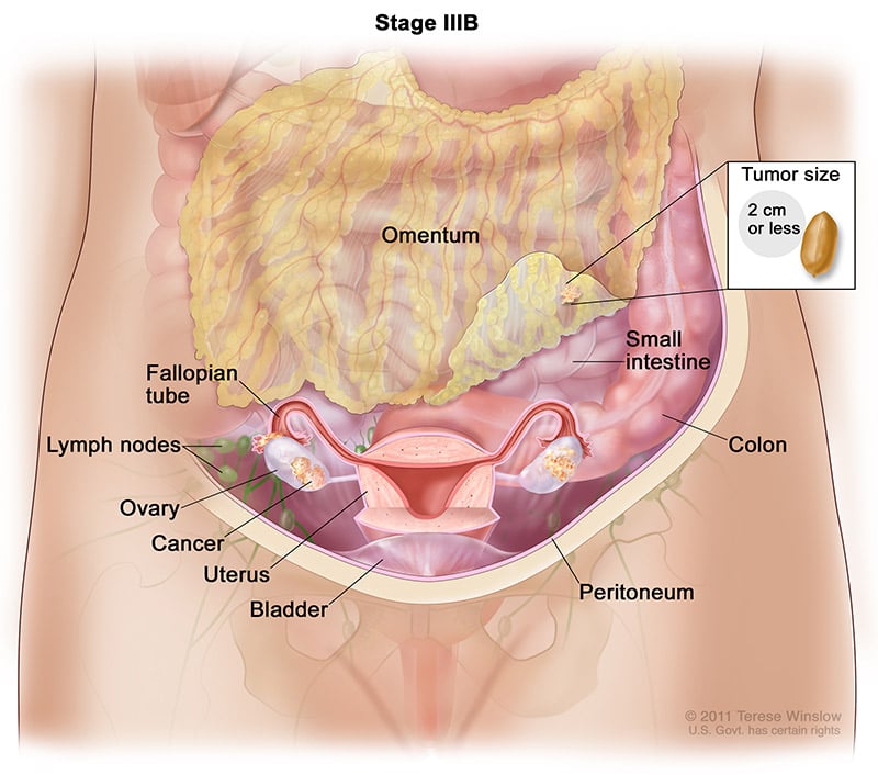 ofp-ca-stage-3B