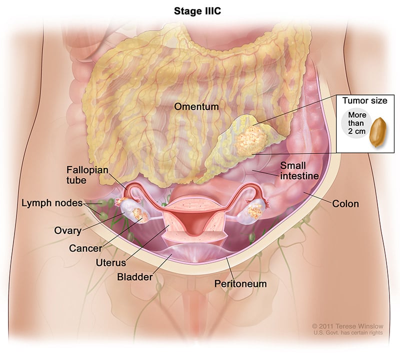 ofp-ca-stage-3C