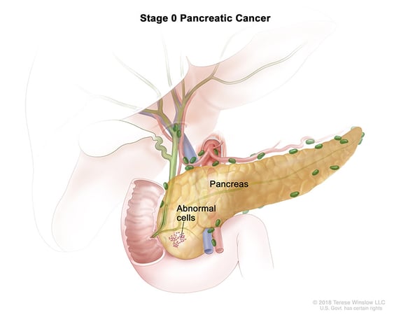 Ilustración médica del estadio 0 del cáncer de páncreas.