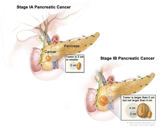 Ilustración médica de los estadios IA y IB del cáncer de páncreas.