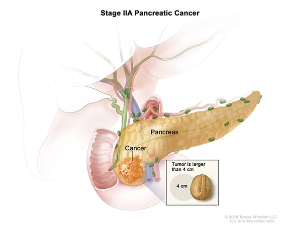 Ilustración médica del estadio IIA del cáncer de páncreas.