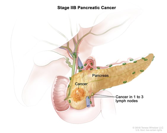 Ilustración médica del estadio IIB del cáncer de páncreas.