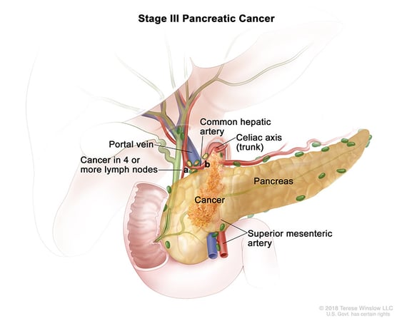 Ilustración médica del estadio III del cáncer de páncreas.