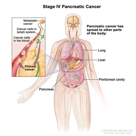 Ilustración médica del estadio IV del cáncer de páncreas.