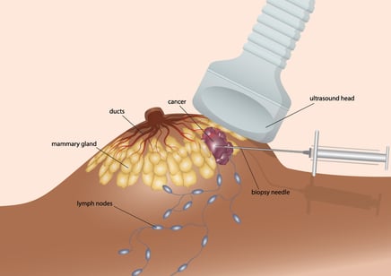 shutterstock_1137758954Liquid biopsy for cancer diagnosis will replace surgical biopsy in future cancer treatment