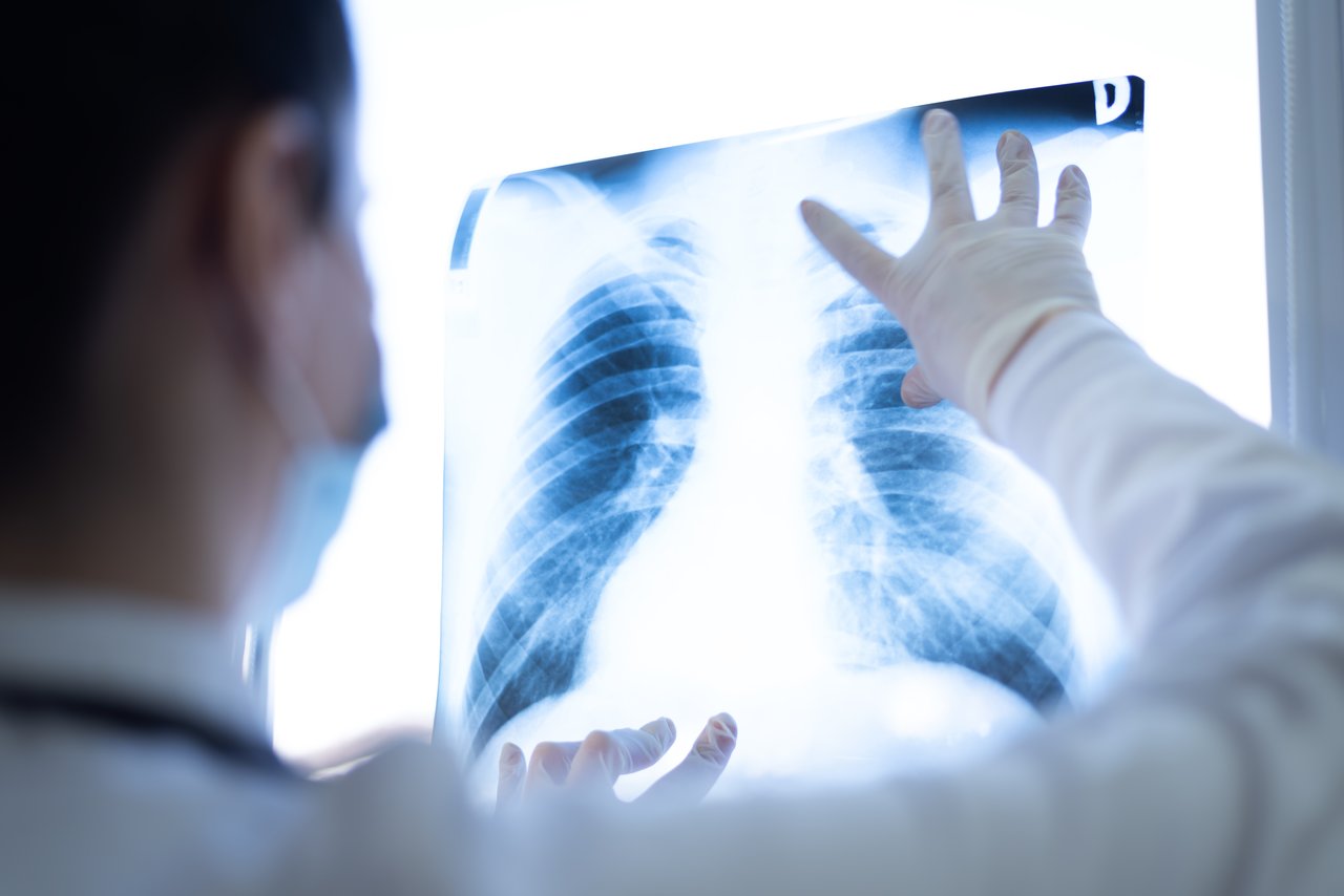 ¿Cuáles son los síntomas del cáncer de pulmón?