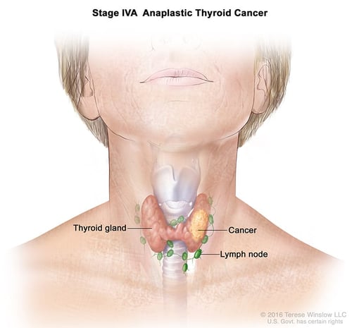 щитовидная железа-ка-анапластическая-стадия4А