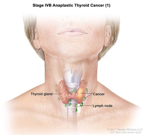 щитовидная железа-ка-анапластическая-стадия4BЧасть1