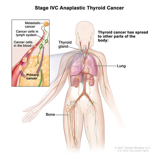 thyroid-ca-anaplastic-stage4C