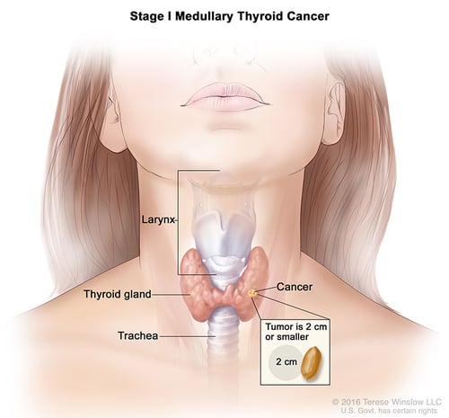 thyroid-ca-medullary-stage-1
