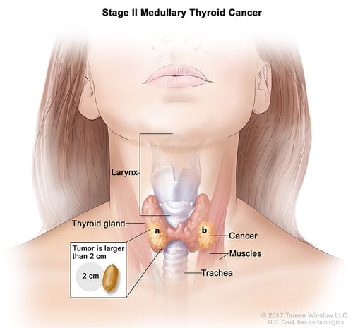 thyroid-ca-medullary-stage-2