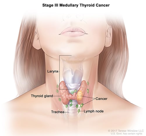 tiroides-ca-medular-etapa-3