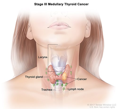 thyroid-ca-medullary-stage-3